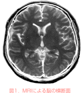 図1．MRIによる脳の横断面