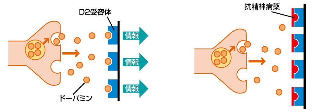 ジスキネジア 症状